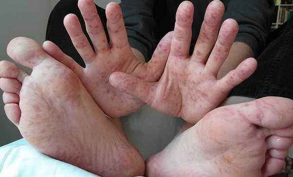 Nổi Mẩn Đỏ Ở Chân Tay Là Bệnh Gì? 10 Nguyên Nhân Thường Gặp