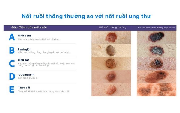 Nốt ruồi ung thư là gì? Cách nhận biết qua nguyên tắc ABCDE