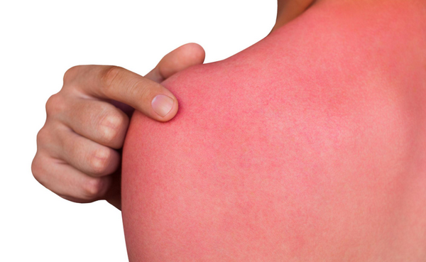 Phân biệt rám nắng và cháy nắng: Nguyên nhân và hướng xử lý phù hợp