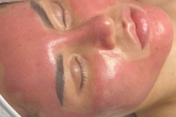 Phục Hồi Da Sau Laser: Cách Chăm Sóc Giúp Da Nhanh Lành Và Hạn Chế Biến Chứng