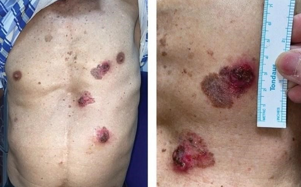 Tổn thương tiền ung thư da là gì? Dấu hiệu nhận biết và cách phòng ngừa
