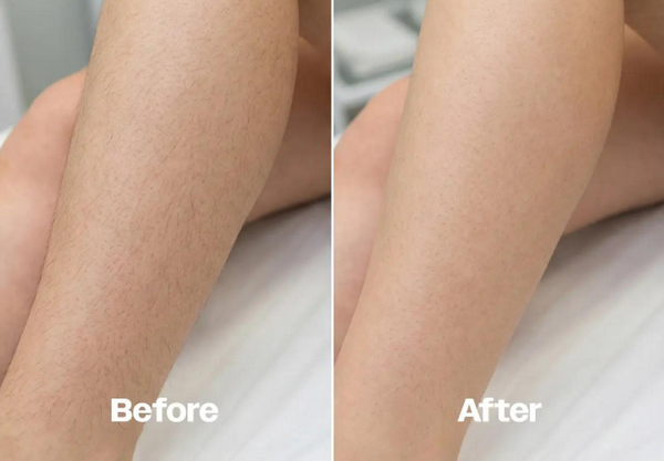 Triệt lông có bị ung thư da không? Lưu ý an toàn