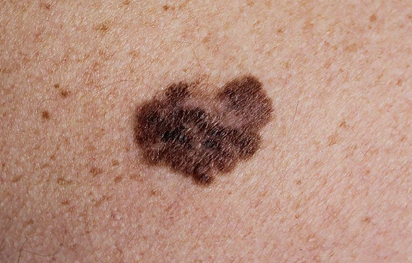 Ung thư da hắc tố (Melanoma): Dấu hiệu nhận biết, nguyên nhân và cách điều trị