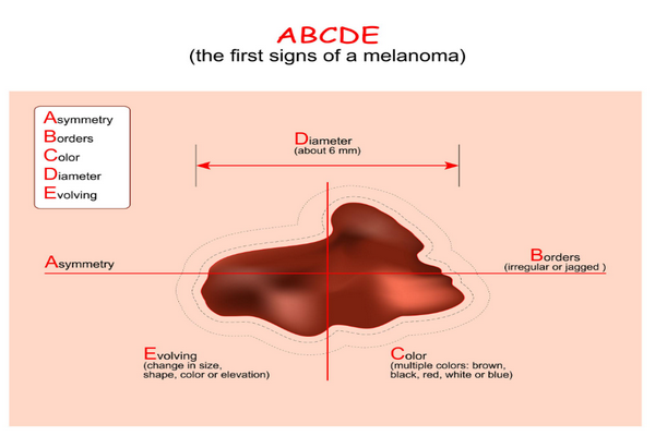 Ung thư da hắc tố (Melanoma)