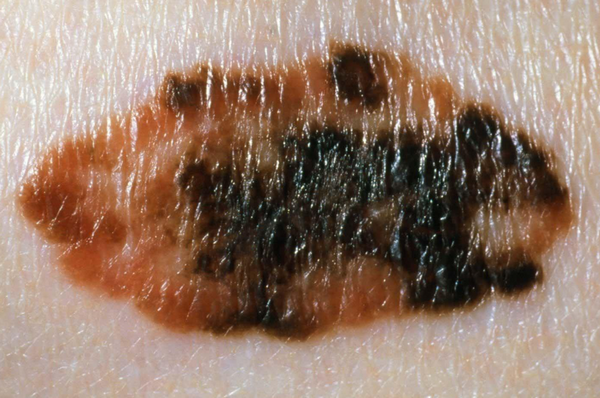 Ung thư da hắc tố (Melanoma)