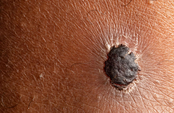 Ung thư da hắc tố (Melanoma)