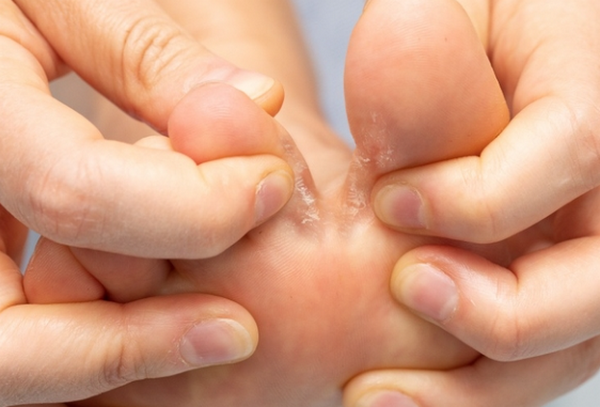 Viêm Kẽ Da Là Gì? Nguyên Nhân, Dấu Hiệu Và Cách Điều Trị
