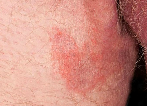 Viêm Kẽ Da Là Gì? Nguyên Nhân, Dấu Hiệu Và Cách Điều Trị