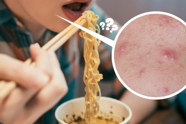 Ăn mì tôm nổi mụn trứng cá [Sự thật và cách phòng tránh hiệu quả]