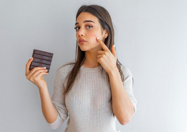 Ăn socola nổi mụn không? Cần lưu ý điều gì?