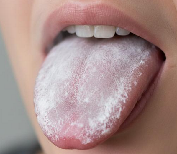 Bệnh Nấm Lưỡi: Nguyên Nhân, Dấu Hiệu Và Cách Điều Trị