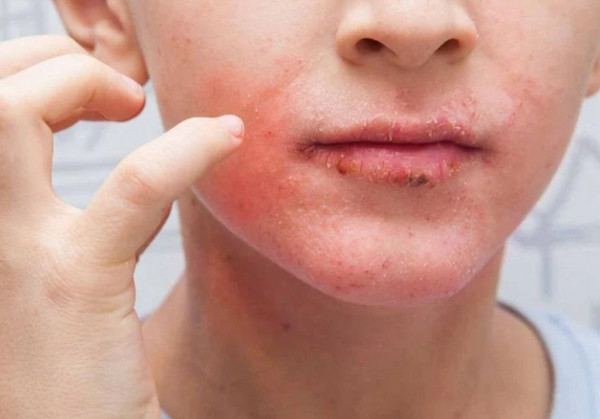 Da mặt nổi mẩn đỏ và ngứa là bị làm sao? Có nguy hiểm không