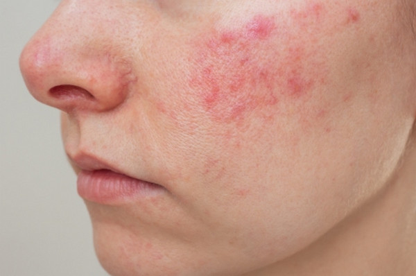 Da mặt nổi mẩn đỏ và ngứa là bị làm sao? Có nguy hiểm không