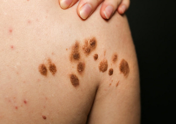 Da Nổi Đốm Nâu Không Do Đâu? Cách Xử Lý Hiệu Quả