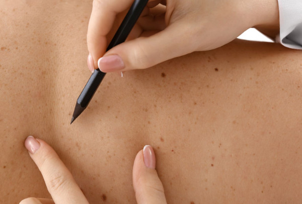 Da Nổi Đốm Nâu Không Do Đâu? Cách Xử Lý Hiệu Quả