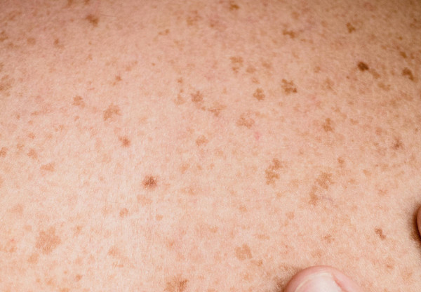 Da Nổi Đốm Nâu Không Do Đâu? Cách Xử Lý Hiệu Quả