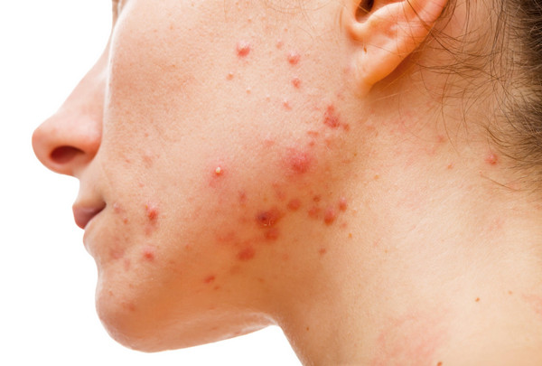 Hình Ảnh Mụn Nội Tiết: Cách Nhận Biết Chính Xác Qua Từng Giai Đoạn