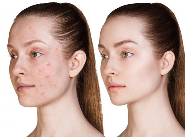 Hình Ảnh Mụn Nội Tiết: Cách Nhận Biết Chính Xác Qua Từng Giai Đoạn