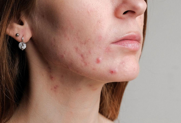 Hình Ảnh Mụn Nội Tiết: Cách Nhận Biết Chính Xác Qua Từng Giai Đoạn