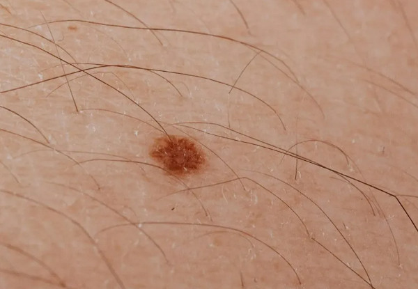 Lông Mọc Trên Nốt Ruồi Có Nguy Hiểm Không? Giải Đáp Từ Bác Sĩ Da Liễu