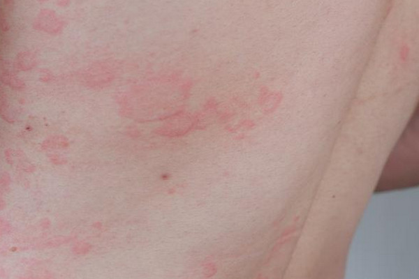 Mày đay mạn tính là gì? Bệnh có điều trị được không?