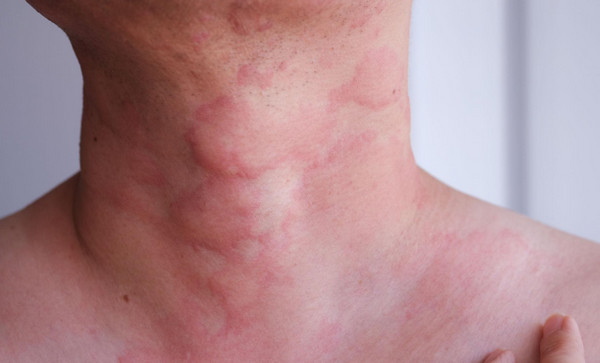Mày đay mạn tính là gì? Bệnh có điều trị được không?