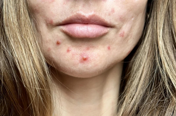 Mụn Mãn Kinh Là Gì? Nguyên Nhân Và Cách Điều Trị Hiệu Quả
