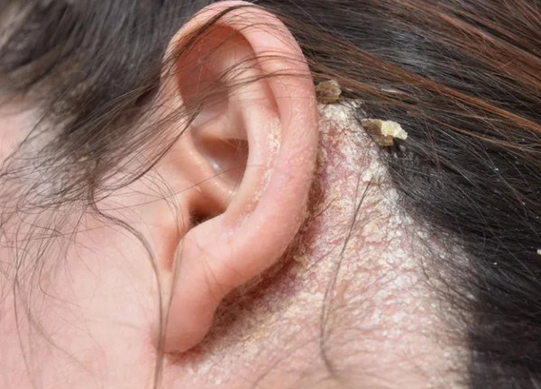 Những vùng da dễ bị nấm nhất trên cơ thể? Dấu hiệu nhận biết mắc nấm da 