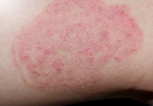 Những vùng da dễ bị nấm nhất trên cơ thể? Dấu hiệu nhận biết mắc nấm da 