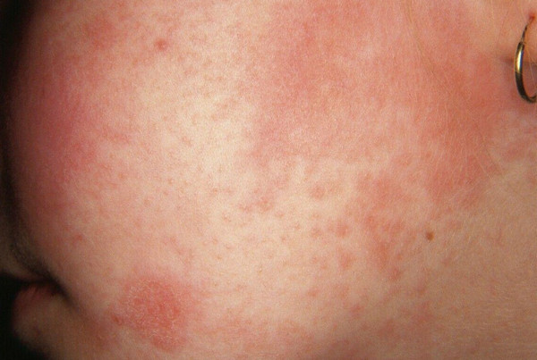 Nổi mề đay ở mặt do đâu? Cách điều trị hiệu quả