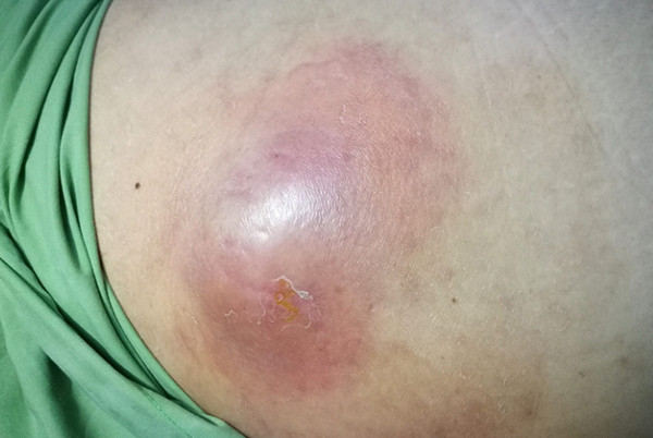 Áp xe mông có nguy hiểm không? Cách điều trị và phòng ngừa