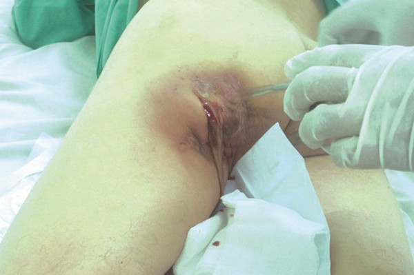 Áp xe mông có nguy hiểm không? Cách điều trị và phòng ngừa