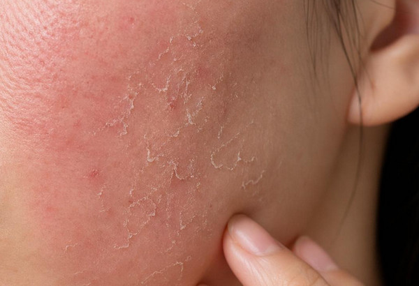 Da Mỏng Do Kem Trộn: Dấu Hiệu Nhận Biết Và Cách Phục Hồi