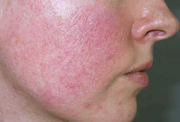 Da Mỏng Do Kem Trộn: Dấu Hiệu Nhận Biết Và Cách Phục Hồi