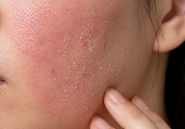 Da nhạy cảm có dùng được Retinol không? Vì sao?