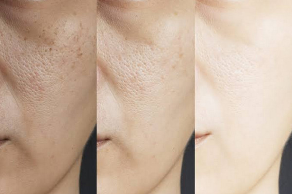 Điều trị lỗ chân lông to tại phòng khám: Phương pháp nào phù hợp với bạn?