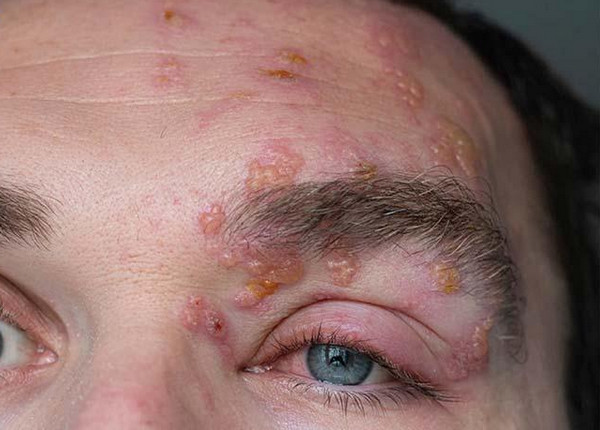 Giời leo là bệnh gì? Nguyên nhân, triệu chứng và cách điều trị