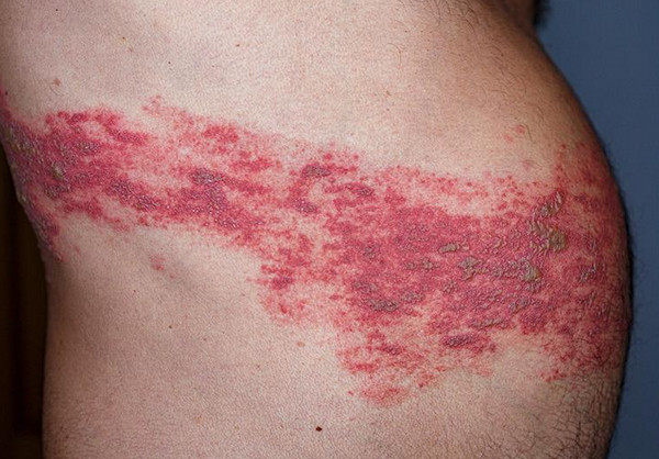Giời leo là bệnh gì? Nguyên nhân, triệu chứng và cách điều trị