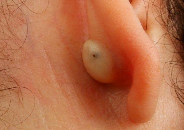 Kén bã đậu là gì?