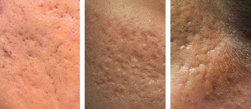 Sẹo rỗ do mụn: Phân biệt và lựa chọn phương pháp điều trị