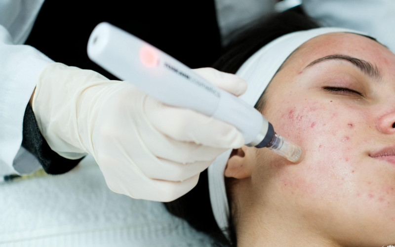 Sẹo rỗ do mụn: Phân biệt và lựa chọn phương pháp điều trị