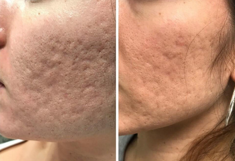 Sẹo rỗ do mụn: Phân biệt và lựa chọn phương pháp điều trị