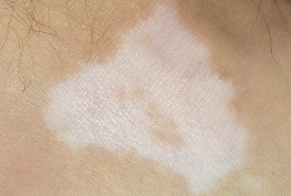 Bạch biến có lây không? Có điều trị được không?