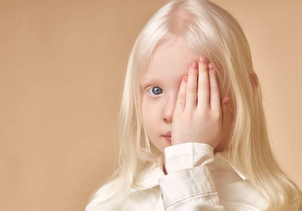 Bạch tạng có chữa được không? Làm cách nào để cải thiện?