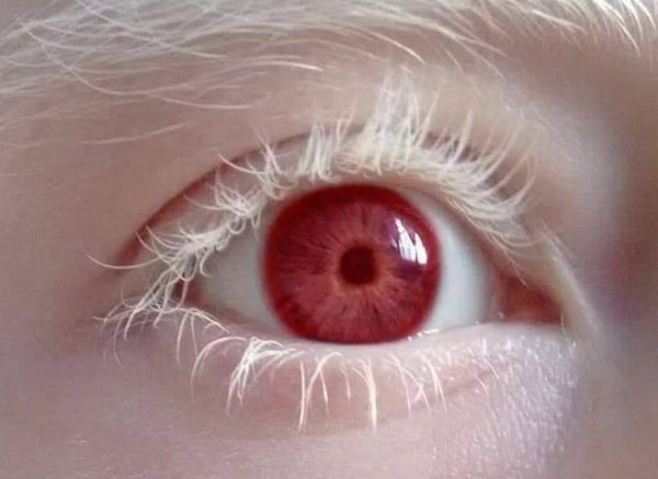 Bạch tạng có chữa được không? Làm cách nào để cải thiện?