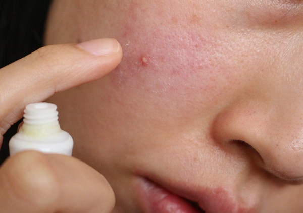 Chấm mụn là gì? Cách chấm mụn đúng cách