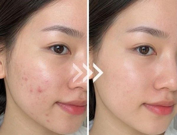 Chấm mụn là gì? Cách chấm mụn đúng cách