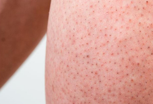 Chân dâu tây là gì? Cách phân biệt và điều trị hiệu quả