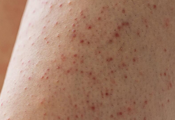 Chân dâu tây là gì? Cách phân biệt và điều trị hiệu quả