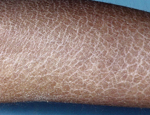 Da vảy cá: Nguyên nhân, dấu hiệu và cách điều trị